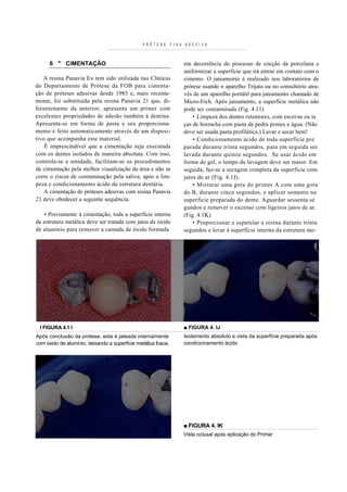 P R Ó T E S E   F I X A A D E S I V A



      6 " ClMENTAÇÃO                                                   em decorrência do processo de cocção da porcelana e
                                                                       uniformizar a superfície que irá entrar em contato com o
    A resina Panavia Ex tem sido utilizada nas Clínicas                cimento. O jateamento é realizado nos laboratórios de
do Departamento de Prótese da FOB para cimenta-                        prótese usando o aparelho Trijato ou no consultório atra-
ção de próteses adesivas desde 1985 e, mais recente-                   vés de um aparelho portátil para jateamento chamado de
mente, foi substituída pela resina Panavia 21 que, di-                 Micro-Etch. Após jateamento, a superfície metálica não
fe rentemen te da anterior, apresenta um primer com                    pode ser contaminada (Fig. 4.11)
excelentes propriedades de adesão também à dentina.                        • Limpeza dos dentes retentores, com escovas ou ta
Apresenta-se em forma de pasta e seu proporciona-                      ças de borracha com pasta de pedra pomes e água. (Não
mento é feito automaticamente através de um disposi-                   deve ser usada pasta profilática.) Lavar e secar bem!
tivo que acompanha este material.                                          • Condicionamento ácido de toda superfície pre
     É imprescindível que a cimentação seja executada                  parada durante trinta segundos, para em seguida ser
com os dentes isolados de maneira absoluta. Com isso,                  lavada durante quinze segundos. Se usar ácido em
controla-se a umidade, facilitam-se os procedimentos                   forma de gel, o tempo de lavagem deve ser maior. Em
de cimentação pela melhor visualização da área e não se                seguida, faz-se a secagem completa da superfície com
corre o riscos de contaminação pela saliva, após a lim-                jatos de ar (Fig. 4.1J).
peza e condicionamento ácido da estrutura dentária.                        • Misturar uma gota do primer A com uma gota
    A cimentação de próteses adesivas com resina Panavia               do B, durante cinco segundos, e aplicar somente na
21 deve obedecer a seguinte sequência:                                 superfície preparada do dente. Aguardar sessenta se
                                                                       gundos e remover o excesso com ligeiros jatos de ar.
   • Previamente à cimentação, toda a superfície interna               (Fig. 4.1K)
da estrutura metálica deve ser tratada com jatos de óxido                  • Proporcionar e espatular a resina durante trinta
de alumínio para remover a camada de óxido formada                     segundos e levar à superfície interna da estrutura me-




 I FIGURA 4.1 I                                                        ■ FIGURA 4. IJ
Após conclusão da prótese, esta é jateada internamente                 Isolamento absoluto e vista da superfície preparada após
com óxido de alumínio, deixando a superfície metálica fosca.           condicionamento ácido




                                                                       ■ FIGURA 4. IK
                                                                       Vista oclusal após aplicação do Primer
 