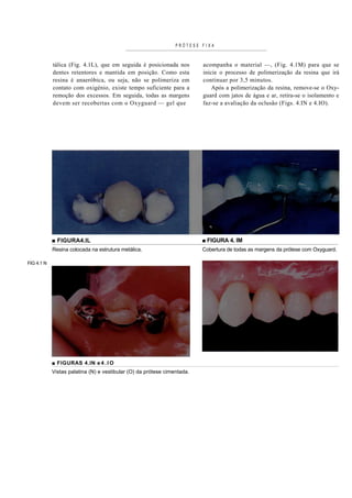 PRÓTESE FIXA



            tálica (Fig. 4.1L), que em seguida é posicionada nos         acompanha o material —, (Fig. 4.1M) para que se
            dentes retentores e mantida em posição. Como esta            inicie o processo de polimerização da resina que irá
            resina é anaeróbica, ou seja, não se polimeriza em           continuar por 3,5 minutos.
            contato com oxigénio, existe tempo suficiente para a             Após a polimerização da resina, remove-se o Oxy-
            remoção dos excessos. Em seguida, todas as margens           guard com jatos de água e ar, retira-se o isolamento e
            devem ser recobertas com o Oxyguard — gel que                faz-se a avaliação da oclusão (Figs. 4.IN e 4.IO).




            ■ FIGURA4.IL                                                 ■ FIGURA 4. IM
            Resina colocada na estrutura metálica.                       Cobertura de todas as margens da prótese com Oxyguard.

FIG 4.1 N




            ■ FIGURAS 4.IN e 4 . I O
            Vistas palatina (N) e vestibular (O) da prótese cimentada.
 