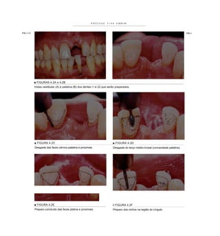 P R Ó T E S E   F I X A   A DESI VA




FIG 4.2A                                                                                                                                 FIG 4.:




           ■ FIGURAS 4.2A e 4.2B
           Vistas vestibular (A) e palatina (B) dos dentes I I e 22 que serão preparados.




           ■ FIGURA 4.2C                                                      ■ FIGURA 4.2D
           Desgaste das faces cérvico-palatina e proximais.                    Desgaste do terço médio-incisal (concavidade palatina).




           ■ FIGURA 4.2E                                                      II FIGURA 4.2F
           Preparo concluído das faces platina e proximais.                    Preparo dos nichos na região do cíngulo.
 
