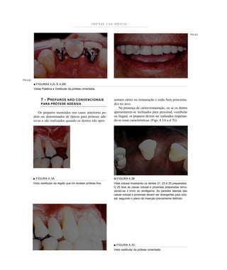 P R Ó T E S E   F I X A   A D E S I V A



                                                                                                                                                  FIG 4.2




FIG 4.2L
           ■ FIGURAS 4.2L E 4.2M
           Vistas Palatina e Vestibular da prótese cimentada.


                 7 - P REPAROSNÃO CONVENCIONAIS                                     sentam cáries ou restauração e estão bem posiciona-
                 PARA PRÓTESE ADESIVA                                               dos no arco.
                                                                                       Na presença de cáries/restauração, ou se os dentes
              Os preparos mostrados nos casos anteriores po-                        apresentarem-se inclinados para proximal, vestibular
           dem ser denominados de típicos para próteses ade-                        ou lingual, os preparos devem ser realizados respeitan-
           sivas e são realizados quando os dentes não apre-                        do-se essas características. (Figs. 4.3A a 4.7G)




           ■ FIGURA 4.3A                                                            M FIGURA 4.3B
           Vista vestibular da região que irá receber prótese fixa.                 Vista oclusal mostrando os dentes 21, 23 e 25 preparados.
                                                                                    O 25 teve as caixas oclusal e proximais preparadas remo-
                                                                                    vendo-se ± Imnn do amálgama. As paredes laterais das
                                                                                    caixas oclusal e proximais devem ser divergentes para oclu-
                                                                                    sal, seguindo o plano de inserção previamente definido.




                                                                                    ■ FIGURA 4.3C
                                                                                    Vista vestibular da prótese cimentada.
 