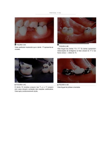 PRÓTESE   FIXA




  FIGURA 4.4A
                                                             FIGURA 4.4B
Vista vestibular mostrando que o dente 17 apresenta-se
cruzado.                                                   Vista lingual dos dentes 15 e 17. Os dentes apresentam
                                                           restaurações de amálgama na fase oclusal do 17 e nas
                                                           faces ocluso — distai do 15.




■ F IGURA 4.4C                                             ■ FIGURA 4.4D
O dente 15 recebeu preparo tipo 4 / 5 e o 17 preparo       Vista lingual da prótese cimentada.
com caixa oclusal e proteção das cúspides vestibulares.
Vista após condicionamento ácido.
 
