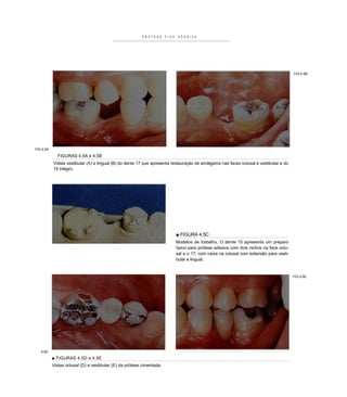 P R Ó T E S E   F I X A    A D E S I V A




                                                                                                                                                FIG 4.5B




FIG 4.5A

             FIGURAS 4.5A e 4.5B
           Vistas vestibular (A) e lingual (B) do dente 17 que apresenta restauração de amálgama nas faces oclusal e vestibular e do
           15 íntegro.




                                                                                    ■ FIGURA 4.5C
                                                                                    Modelos de trabalho, O dente 15 apresenta um preparo
                                                                                    típico para prótese adesiva com dois nichos na face oclu-
                                                                                    sal e o 17, com caixa na oclusal com extensão para vesti-
                                                                                    bular e lingual.


                                                                                                                                                FIG 4.5E




   4.5D
           ■ FIGURAS 4.5D e 4.5E
           Vistas oclusal (D) e vestibular (E) da prótese cimentada.
 