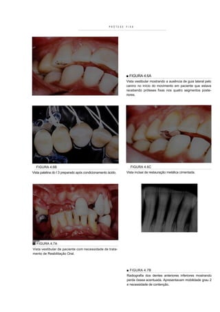 PRÓTESE   FIXA




                                                               ■ FIGURA 4.6A
                                                               Vista vestibular mostrando a ausência de guia lateral pelo
                                                               canino no início do movimento em paciente que estava
                                                               recebendo próteses fixas nos quatro segmentos poste-
                                                               riores.




  FIGURA 4.6B                                                    FIGURA 4.6C
Vista palatina do I 3 preparado após condicionamento ácido.    Vista incisai da restauração metálica cimentada.




   FIGURA 4.7A
Vista vestibular de paciente com necessidade de trata-
mento de Reabilitação Oral.



                                                               ■ FIGURA 4.7B
                                                               Radiografia dos dentes anteriores inferiores mostrando
                                                               perda óssea acentuada. Apresentavam mobilidade grau 2
                                                               e necessidade de contenção.
 