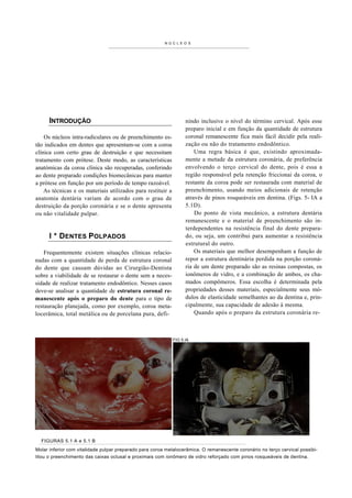 NÚCL E O S




      INTRODUÇÃO                                                   nindo inclusive o nível do término cervical. Após esse
                                                                   preparo inicial e em função da quantidade de estrutura
    Os núcleos intra-radiculares ou de preenchimento es-           coronal remanescente fica mais fácil decidir pela reali-
tão indicados em dentes que apresentam-se com a coroa              zação ou n ão do tratamento endodôntico.
clínica com certo grau de destruição e que necessitam                  Uma regra básica é que, existindo aproximada-
tratamento com prótese. Deste modo, as características             mente a metade da estrutura coronária, de preferência
anatómicas da coroa clínica são recuperadas, conferindo            envolvendo o terço cervical do dente, pois é essa a
ao dente preparado condições biomecânicas para manter              região responsável pela retenção friccionai da coroa, o
a prótese em função por um período de tempo razoável.              restante da coroa pode ser restaurada com material de
    As técnicas e os materiais utilizados para restituir a         preenchimento, usando meios adicionais de retenção
anatomia dentária variam de acordo com o grau de                   através de pinos rosqueáveis em dentina. (Figs. 5- IA a
destruição da porção coronária e se o dente apresenta              5.1D).
ou não vitalidade pulpar.                                              Do ponto de vista mecânico, a estrutura dentária
                                                                   remanescente e o material de preenchimento são in-
                                                                   terdependentes na resistência final do dente prepara-
      I * DENTES POLPADOS                                          do, ou seja, um contribui para aumentar a resistência
                                                                   estrutural do outro.
    Frequentemente existem situações clínicas relacio-                 Os materiais que melhor desempenham a função de
nadas com a quantidade de perda de estrutura coronal               repor a estrutura dentinária perdida na porção coroná-
do dente que causam dúvidas ao Cirurgião-Dentista                  ria de um dente preparado são as resinas compostas, os
sobre a viabilidade de se restaurar o dente sem a neces-           ionômeros de vidro, e a combinação de ambos, os cha-
sidade de realizar tratamento endodôntico. Nesses casos            mados compômeros. Essa escolha é determinada pela
deve-se analisar a quantidade de estrutura coronal re-             propriedades desses materiais, especialmente seus mó-
manescente após o preparo do dente para o tipo de                  dulos de elasticidade semelhantes ao da dentina e, prin-
restauração planejada, como por exemplo, coroa meta-               cipalmente, sua capacidade de adesão à mesma.
locerâmica, total metálica ou de porcelana pura, defi-                 Quando após o preparo da estrutura coronária re-



                                                             FIG 5.IA




  FIGURAS 5.1 A e 5.1 B
Molar inferior com vitalidade pulpar preparado para coroa metalocerâmica. O remanescente coronário no terço cervical possibi-
litou o preenchimento das caixas oclusal e proximais com ionômero de vidro reforçado com pinos rosqueáveis de dentina.
 