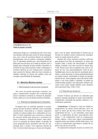 PRÓTESE   FIXA



FIG 5.IC




           «FIGURAS 5.IC e 5.1 D
           Vistas do preparo concluído.


           manescente chegar-se a conclusão que não existe estru-        para a raiz do dente, minimizando as tensões que se
           tura dentária suficiente para resistir às forças mastigató-   formam na interface núcleo metálico/raiz, principal-
           rias, com o risco de ocorrerem fraturas no material de        mente na região apical do núcleo.
           preenchimento, deve-se realizar o tratamento endodôn-             Quando não existe estrutura coronária suficiente
           tico. É importante ressaltar que a desvitalização de um       para propiciar essa base de sustentação, as forças que
           dente para esse fim deve ser evitada ao máximo, pois o        incidem sobre o núcleo são direcionadas no sentido
           preparo para colocação do pino metálico intracanal, ao        oblíquo, tornando a raiz mais suscetível à fratura (Fig.
           contrário do que muitos pensam, tende a enfraquecer a         5.2A). Nesses casos, deve-se preparar uma caixa no in-
           estrutura dentária da raiz remanescente, tornando-a           terior da raiz com aproximadamente 2mm de pro-
           mais suscetível à fraturas, além dos riscos inerentes ao      fundidade para criar-se uma base de sustentação para o
           trabalho realizado no interior do conduto, como por           núcleo e assim direcionar as forças predominantemente
           exemplo, a possibilidade de trepanação.                       no sentido vertical., diminuindo as tensões nas paredes
                                                                         laterais da raiz. Essas pequenas caixas não devem enfra-
                                                                         quecer a raiz nessa região e, portando, só podem ser
                 II - D ENTES D ESPOLPADOS                               confeccionadas quando a raiz apresentar estrutura sufi-
                                                                         ciente. Essas caixas atuarão também como elementos
                 1. RESTAURAÇÃO COM NÚCLEOS FUNDIDOS                     anti-rotacionais (Figs. 5.2B a 5.2E).

              Nos casos de grande destruição coronária, nos                     1.2. P REPARO   DO   C ONDUTO
           quais o remanescente coronário não é suficiente para
           prover resistência estrutural ao material de preenchi-            Existem 4 fatores que devem ser analisados para
           mento, indica-se o uso de núcleos metálicos fundidos.         propiciar retenção adequada ao núcleo intra-radicular:
                                                                         comprimento, inclinação das paredes, diâmetro e ca-
                 1.1. PREPARO DO REMANESCENTE CORONÁRIO                  racterísticas superficial.

               O preparo deve ser realizado seguindo as caracte-             Comprimento: A literatura é vasta em relação ao
           rísticas do tipo de prótese indicado, como comentado          comprimento do núcleo intrar-radicular: deve ser
           anteriormente, removendo-se o cimento temporário              igual ou maior que da coroa clínica, dois terços do
           contido na câmara pulpar até a emboradura do con-             comprimento da raiz, 3/4, etc. Entretanto, como regra
           duto. É muito importante que se preserve o máximo             geral, o comprimento do pino intra-radicular deve
           de estrutura dental para preservar a resistência do           atingir 2/3 do comprimento total do remanescente
           dente e aumentar e retenção da prótese. Após elimi-           dental, embora o meio mais seguro, principalmente
           nar-se as retenções da câmara pulpar, as paredes da           naqueles dentes que tenham sofrido perda óssea, é ter
           coroa preparada devem apresentar uma base de sus-             o pino no comprimento equivalente à metade do su-
           tentação para o núcleo, com espessura mínima de               porte ósseo da raiz envolvida.
           lmm. É através desta base que as forças são dirigidas             O comprimento adequado do pino no interior da
 
