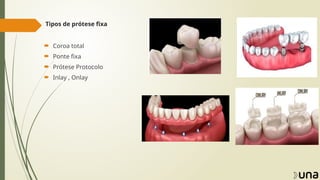 Tipos de prótese fixa
 Coroa total
 Ponte fixa
 Prótese Protocolo
 Inlay , Onlay
 