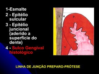 1-Esmalte 2 - Epitélio   sulcular 3 - Epitélio juncional (aderido a superfície do dente)  4 -  Sulco Gengival histológico   Sulco Gengival histológico LINHA DE JUNÇÃO PREPARO-PRÓTESE 