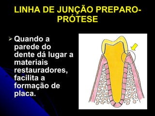 LINHA DE JUNÇÃO PREPARO-PRÓTESE Quando a parede do dente dá lugar a materiais restauradores, facilita a formação de placa. 