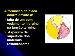 A  formação de placa ocorre devido a:   falta de  um bom vedamento marginal  na junção terminal Aspereza  da superfície dos materiais restauradores 