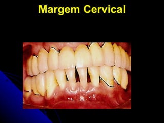 Margem Cervical 