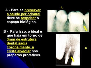 A -  Para se  preservar a saúde periodontal   deve se  respeitar  o espaço biológico. B -  Para isso, o ideal é  que haja em torno de  3mm de estrutura dental sadia coronalmente  a crista alveolar  nos  preparos protéticos. A B 