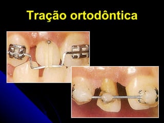 Tração ortodôntica 