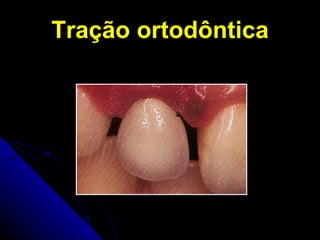 Tração ortodôntica 