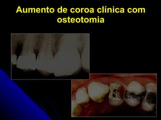 Aumento de coroa clínica com osteotomia 