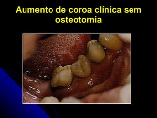 Aumento de coroa clínica sem osteotomia 