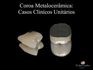 Coroa Metalocerâmica: Casos Clinícos Unitários 