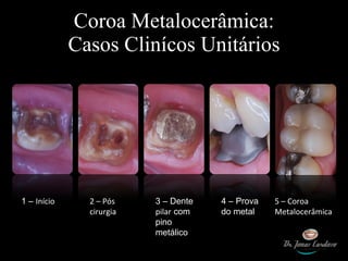 Coroa Metalocerâmica: Casos Clinícos Unitários 1 –  Início   2 – Pós cirurgia 3 – Dente  pilar  com pino metálico  4 – Prova do metal 5 – Coroa Metalocerâmica  