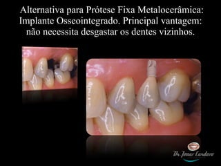 Alternativa para Prótese Fixa Metalocerâmica: Implante Osseointegrado. Principal vantagem: não necessita desgastar os dentes vizinhos. 