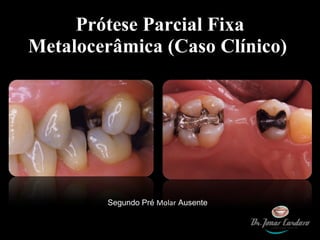 Prótese Parcial Fixa Metalocerâmica (Caso Clínico)  Segundo Pré  Molar  Ausente 