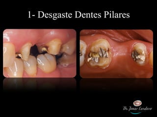 1- Desgaste Dentes Pilares 
