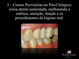 3 – Coroas Provisórias no Pós-Cirúrgico: coroa dental aumentada, melhorando a estética, retenção, função e os procedimentos de higiene oral. 