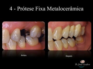 4 - Prótese Fixa Metalocerâmica Antes Depois 