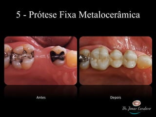 5 - Prótese Fixa Metalocerâmica Antes Depois 