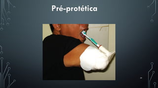 59
Pré-protética
 