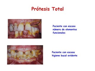 Prótesis Total Paciente con escaso número de elementos funcionales Paciente con escasa higiene bucal evidente 