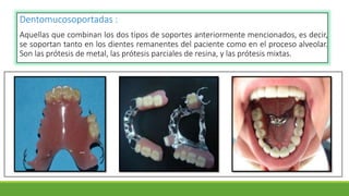 Dentomucosoportadas :
Aquellas que combinan los dos tipos de soportes anteriormente mencionados, es decir,
se soportan tanto en los dientes remanentes del paciente como en el proceso alveolar.
Son las prótesis de metal, las prótesis parciales de resina, y las prótesis mixtas.
 