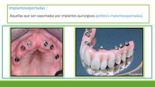 Implantosoportadas :
Aquellas que son soportadas por implantes quirúrgicos (prótesis implantosoportadas).
 