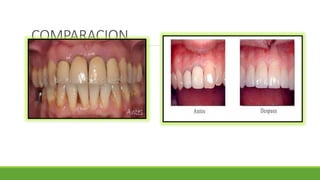COMPARACION
COROMA DE RESINA ACRILICA
 