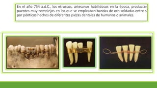 En el año 754 a.d.C., los etruscos, artesanos habilidosos en la época, producían
puentes muy complejos en los que se empleaban bandas de oro soldadas entre sí
por pónticos hechos de diferentes piezas dentales de humanos o animales.
 