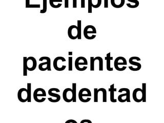 Ejemplos de pacientes desdentados.
