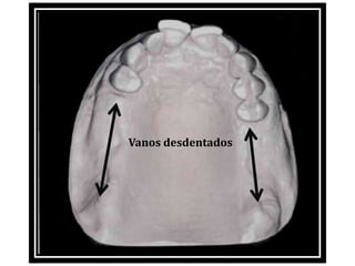 Vanos desdentados