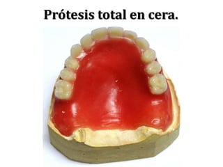 Prótesis total en cera.