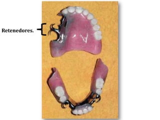 Retenedores.