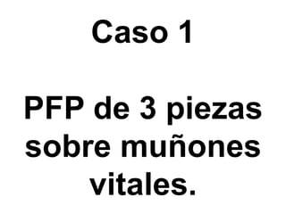 Caso 1PFP de 3 piezas sobre muñones vitales.