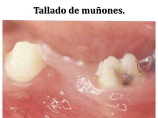 Tallado de muñones.