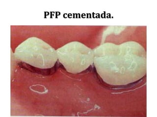 PFP cementada.