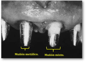 Muñón metálico.Muñón mixto.