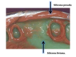 Silicona pesadaSilicona liviana.