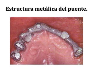 Estructura metálica del puente.