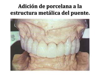 Adición de porcelana a la estructura metálica del puente.