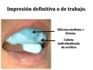 Cubeta individualizada de acrílico.Impresión definitiva o de trabajo.Silicona mediana + liviana.
