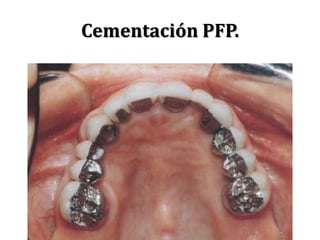 Cementación PFP.