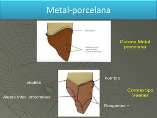 Metal-porcelana

 