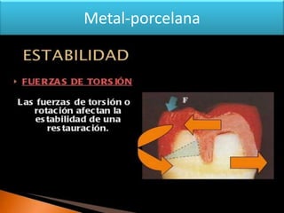 Metal-porcelana

 
