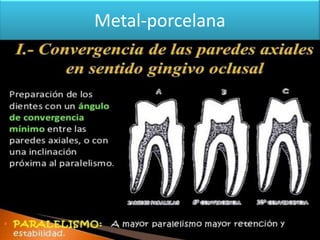Metal-porcelana

 
