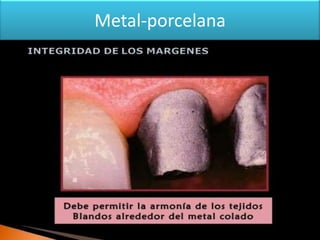 Metal-porcelana

 